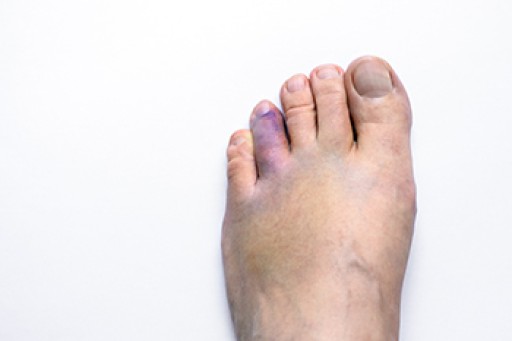 A Possible Treatment for a Broken Toe