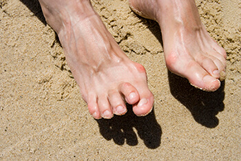 Hammertoes Specialist Hammertoe Treatment in the Ventura County, CA: Thousand Oaks (Simi Valley, Camarillo, Moorpark, Oak Park) and Los Angeles County, CA: Calabasas, Cornell, Agoura Hills areas