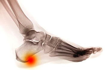 Heel Spurs Specialist Heel spur treatment in the Ventura County, CA: Thousand Oaks (Simi Valley, Camarillo, Moorpark, Oak Park) and Los Angeles County, CA: Calabasas, Cornell, Agoura Hills areas