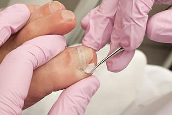 Ingrown Nail Specialist Ingrown toenail treatment in the Ventura County, CA: Thousand Oaks (Simi Valley, Camarillo, Moorpark, Oak Park) and Los Angeles County, CA: Calabasas, Cornell, Agoura Hills areas