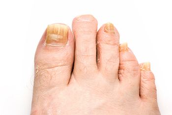 Fungal Toenail Specialist Toenail fungus treatment in the Ventura County, CA: Thousand Oaks (Simi Valley, Camarillo, Moorpark, Oak Park) and Los Angeles County, CA: Calabasas, Cornell, Agoura Hills areas