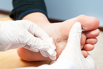 Warts Specialist Warts treatment in the Ventura County, CA: Thousand Oaks (Simi Valley, Camarillo, Moorpark, Oak Park) and Los Angeles County, CA: Calabasas, Cornell, Agoura Hills areas